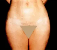 Gedanken vor der Operation - Fettabsaugung 5